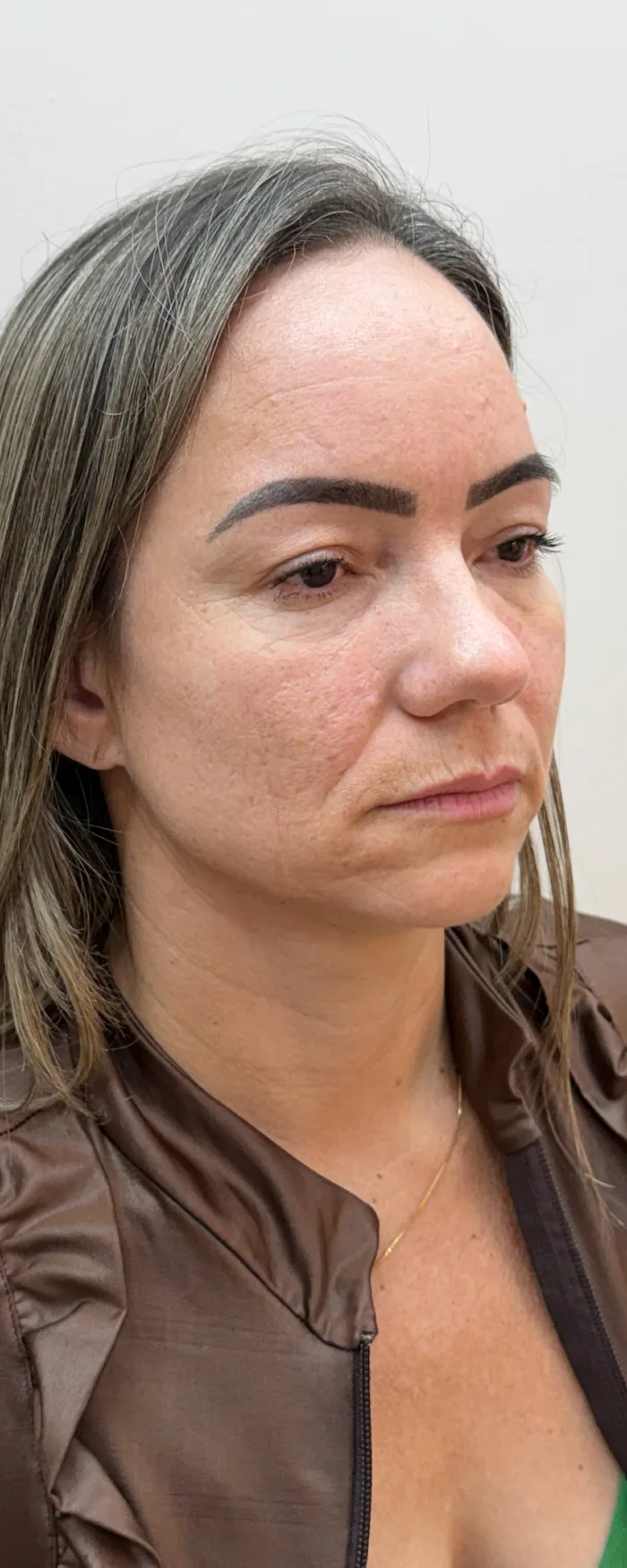 Antes da harmonização facial