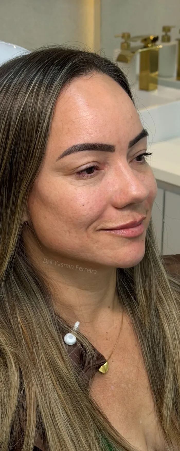 Depois da harmonização facial