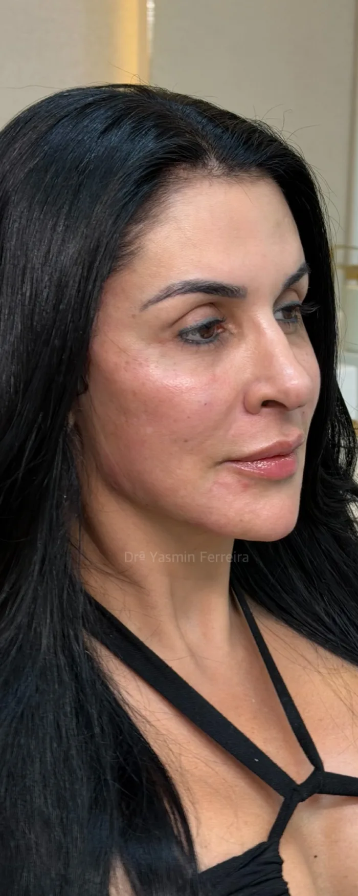 Depois da harmonização facial