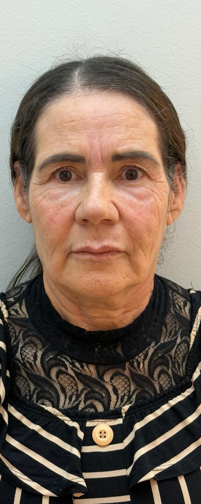 Antes da harmonização facial