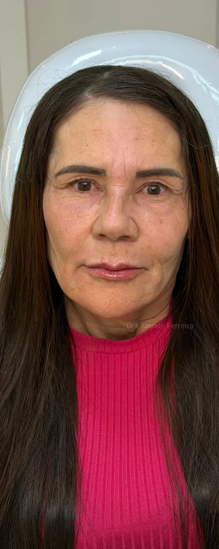 Depois da harmonização facial